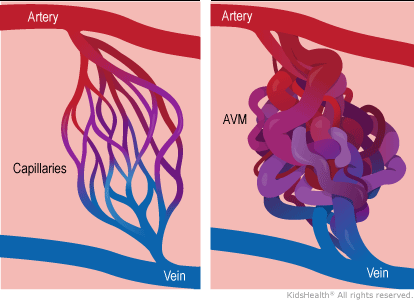 Arteriovenous Malformation treatment in Gurugram , South Delhi
